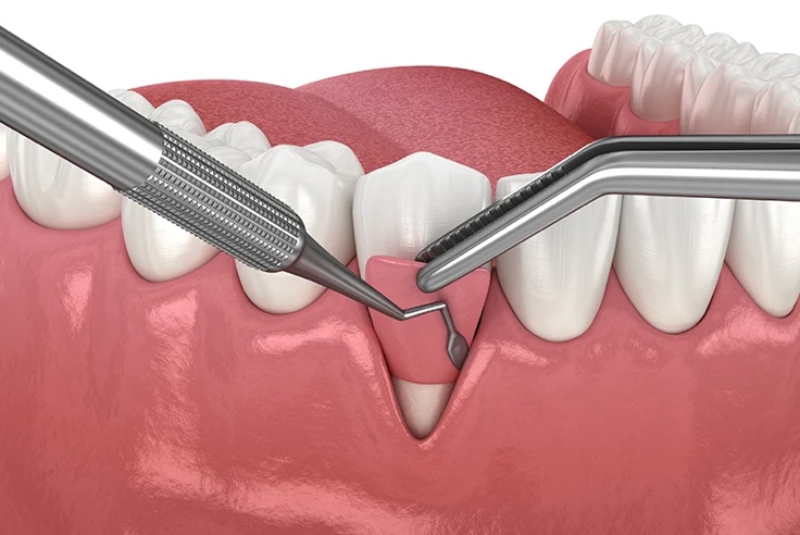 Gum Surgeries