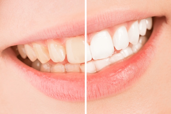 Teeth Whitening