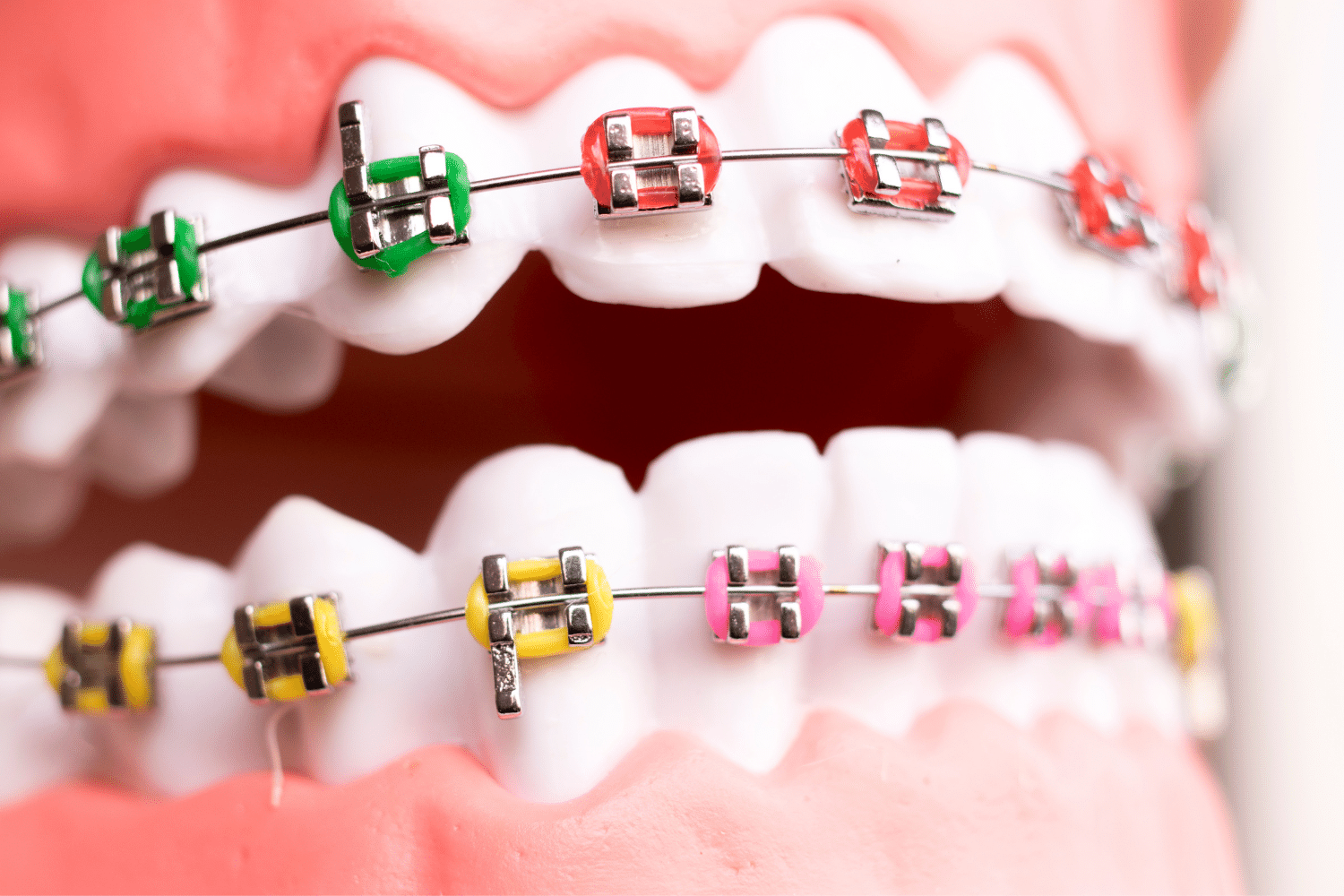 Orthodontic Treatment via Braces